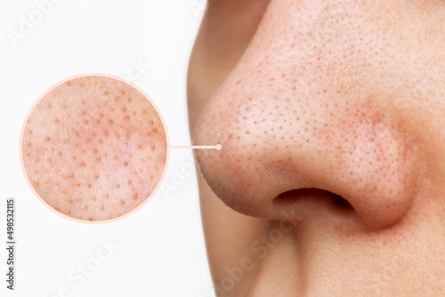Close up of female nose with blackheads or black dots and magnifying glass with an enlarged image of the pores on the face isolated on a white background. Acne problem, comedones. Cosmetology concept