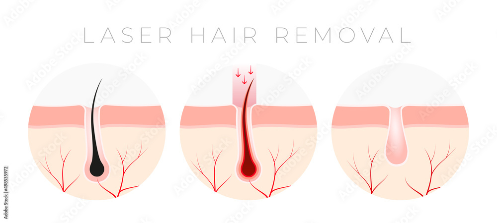 Obraz premium IPL Laser hair removal verctor illustration concept