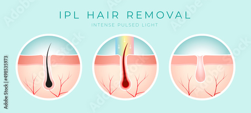 IPL Laser hair removal verctor illustration concept photo