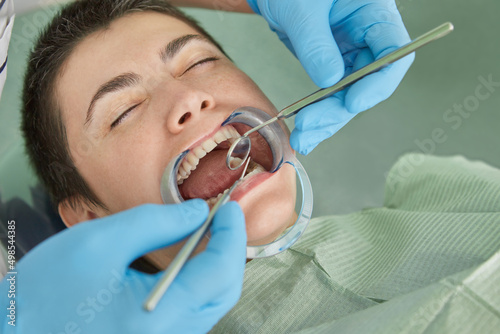 Close up of patient with cheek retractor in mouth receiving dental treatment.