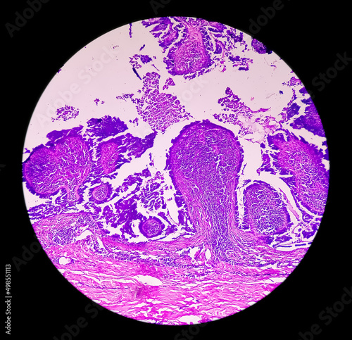 Endometrial (Uterine) cancer awareness: Photomicrograph of uterine biopsy showing Endometrial cancer or Endometrial carcinoma. photo