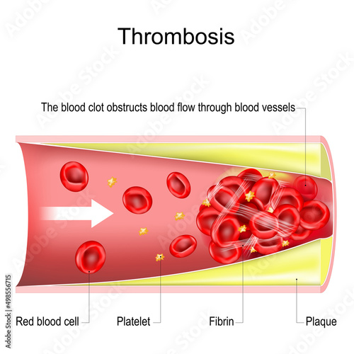 thrombosis. The blood clot obstructs blood flow through blood vessels