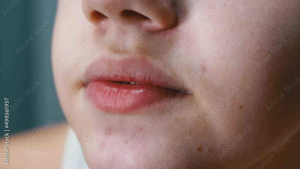 Close-up of Face, Lips, and Mouth of a Talking Teenager with Acne on ...
