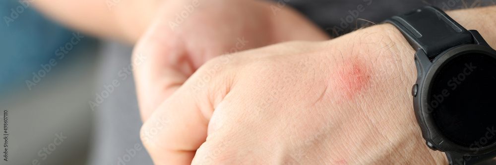 Closeup of red spot on skin of man hand