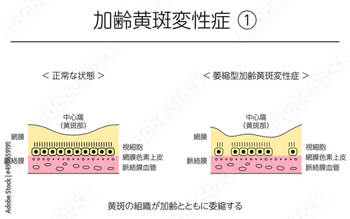 眼病、萎縮型加齢黄斑変性症の図解