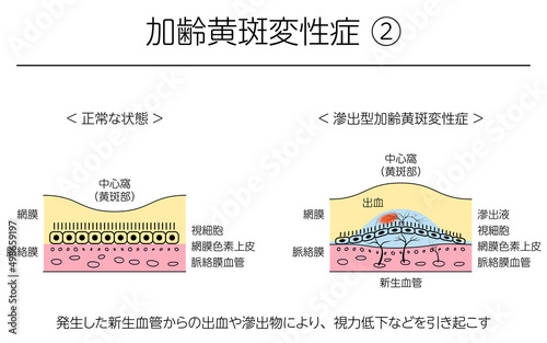 眼病、滲出型加齢黄斑変性症の図解