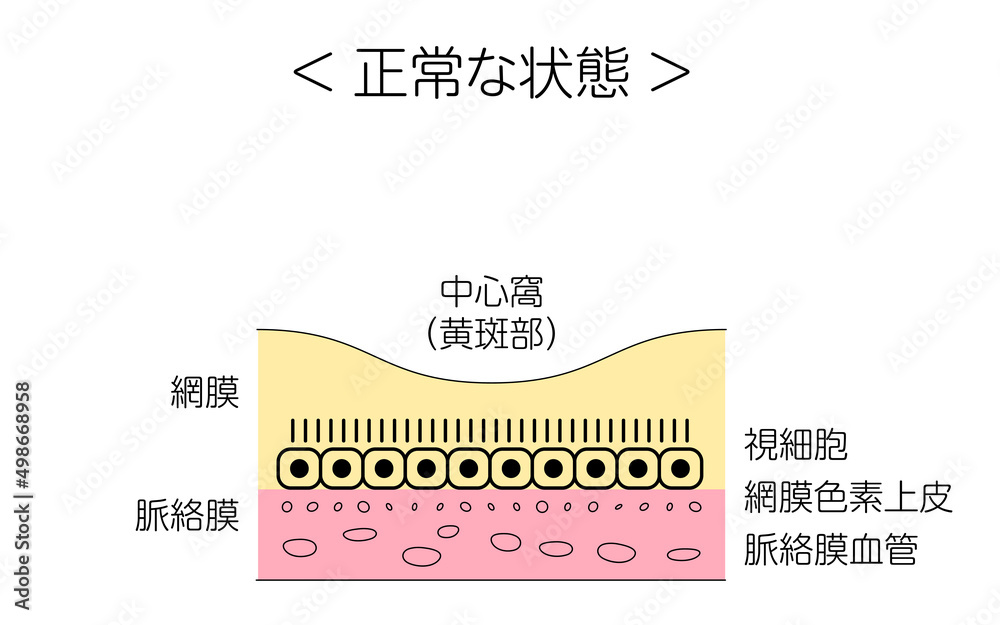 Obraz premium 眼病、加齢黄斑変性症の図解、正常な状態