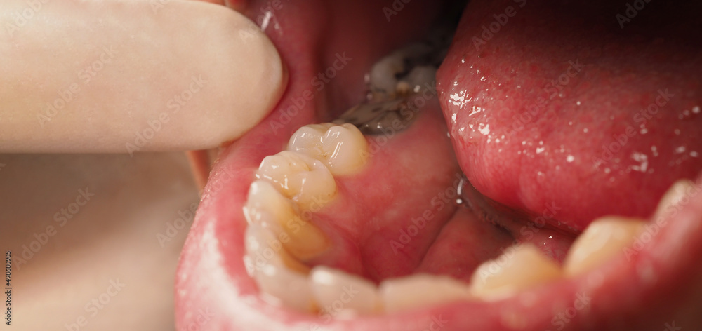 Decayed tooth root canal treatment. Tooth or teeth decay of lower molar. Restoration with a composite filling. Adult caries. bad teeth. Dental temporary restorative material. Dental concept. close up. Decayed tooth root canal treatment. Tooth or teeth decay of lower molar. Restoration with a composite filling. Adult caries. bad teeth. Dental temporary restorative material. Dental concept. close up.