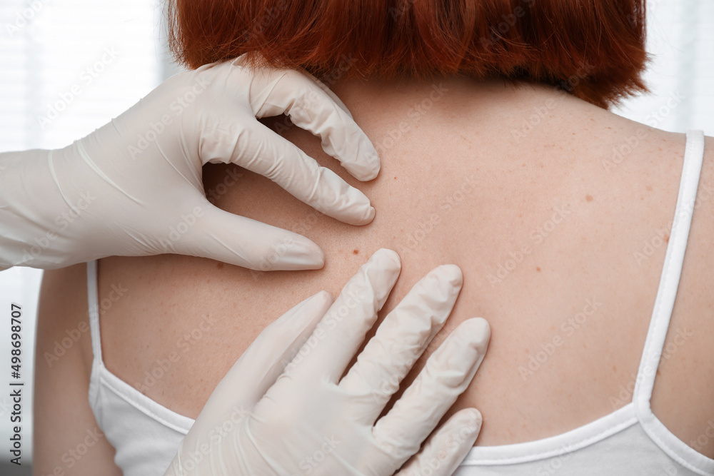 Dermatologist examining patient's birthmark in clinic, closeup view