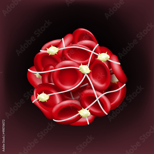 Blood clots block the flow of blood. Red blood cells, platelets and fibrin. photo