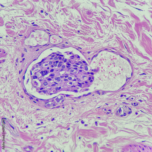 Camera photo of breast carcinoma with lymphovascular invasion, magnification 400x, photograph through a microscope