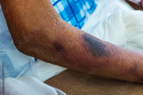 Blood bruises under the skin of an elderly patient photo