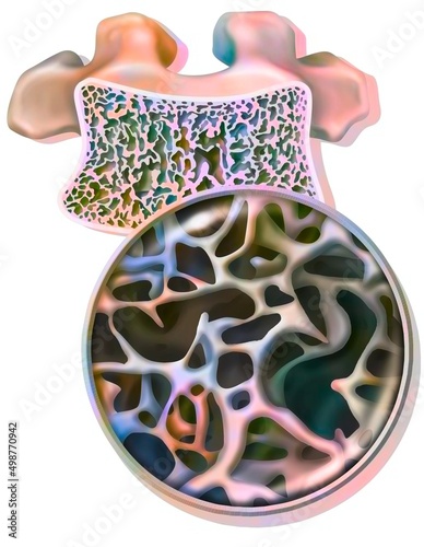 Dorsal vertebrae with osteoporosis with partially destroyed cancellous. photo