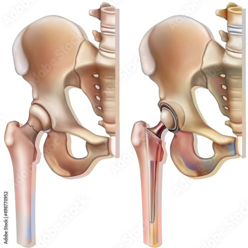 Femoral neck fracture (osteoporosis) and hip prosthesis.