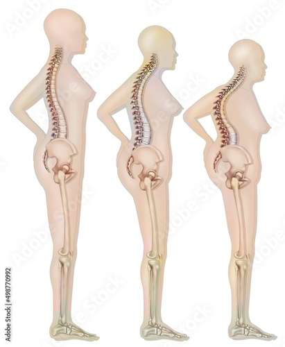 Modification of the silhouette linked to osteoporosis (vertebral.