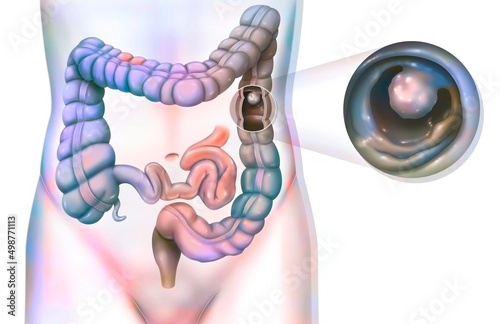 Картината върху платно Digestive system: the colon with a colonic polyp.