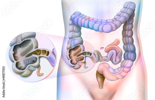 Quadro em tela Colon (large intestine) with a zoom on the cecum.