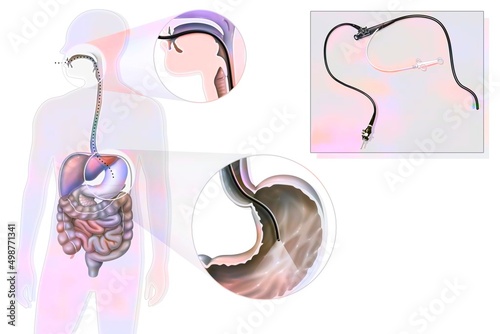Gastroscopy: route and location of the gastro fiberscope introduced. photo
