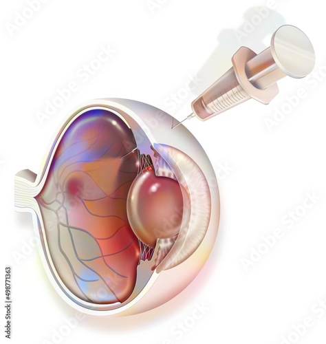 Eye: treatment of macular degeneration by RNA interference. photo