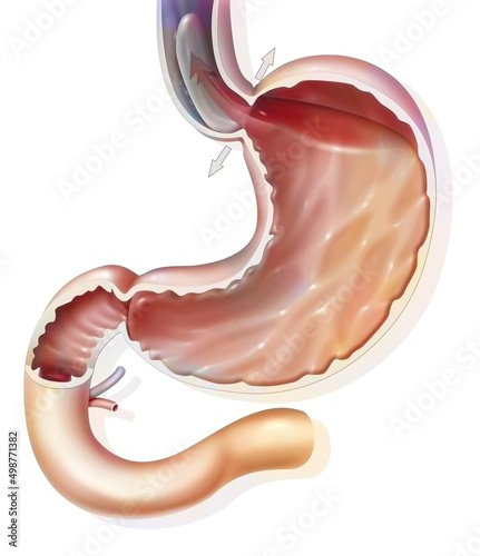 Stomach: gastroesophageal reflux disease in the gastroesophageal. photo