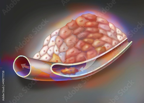 Cancerous tumor stage 3: Cancer cells have multiplied and transformed.