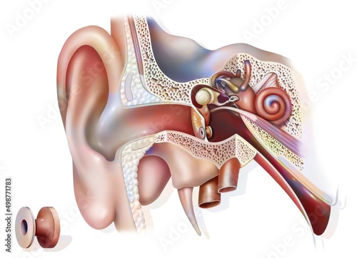 Otitis treatment: tympanic ventilator in the ear to promote. photo
