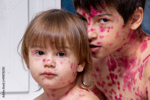 Close-up of cute little children. Chickenpox virus or vesicular rash on a child's body