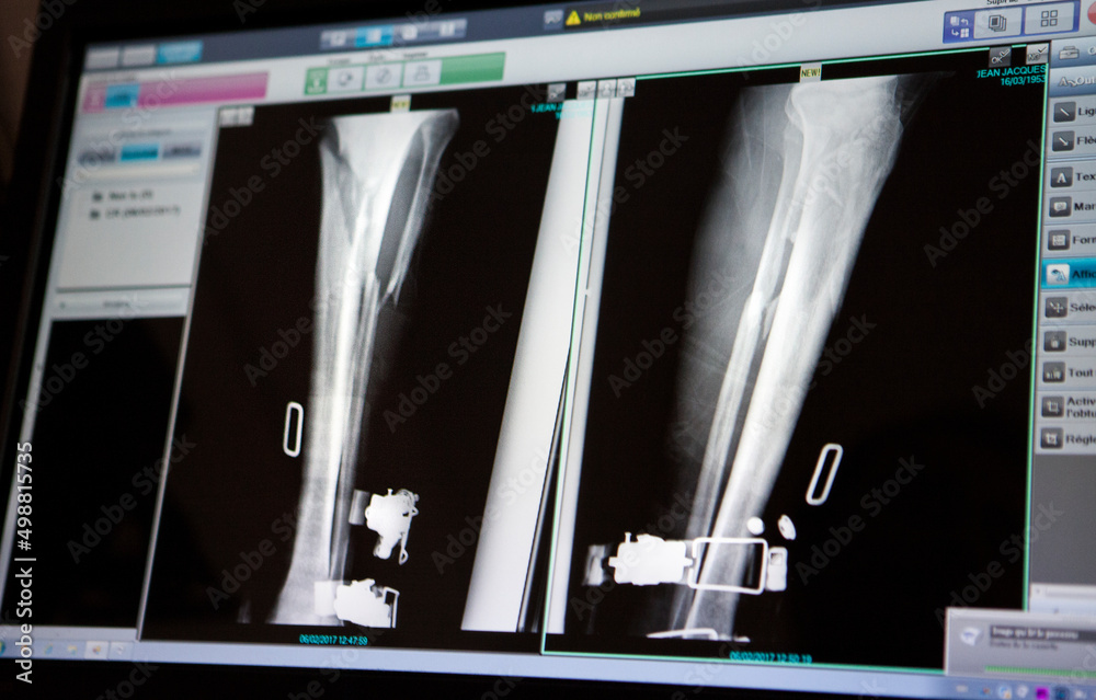 Xray of the leg of a patient had a ski fall with a fractured tibia