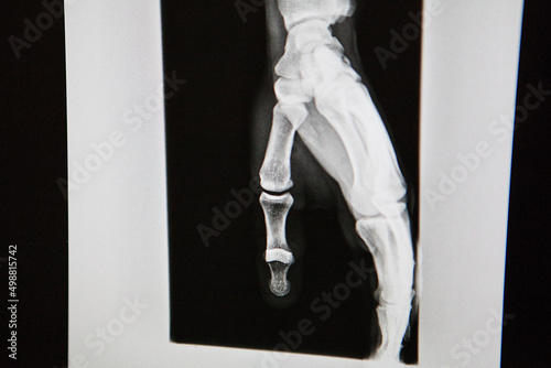 X-ray of an open dislocation of the thumb at a mountain doctor. photo
