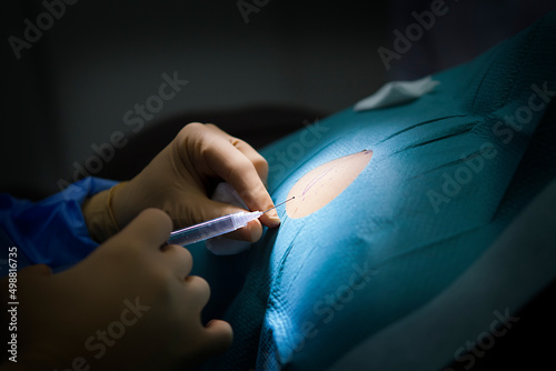 Anesthesia for removal of a cyst in a dermatology practice. photo