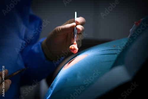 Removal of a cyst by the dermatologist. photo