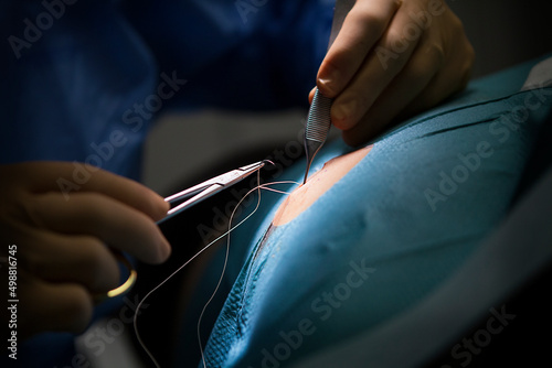 Photos Stitches after removal of a cyst by the dermatologist.