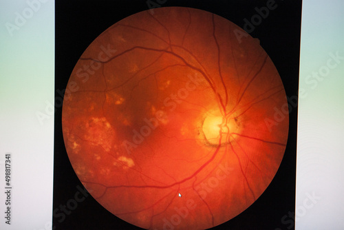 Fundus: routine examination established by an ophthalmoscope to check. photo