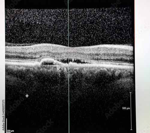 Optical coherence tomography (OCT) of a patient with macular edema.