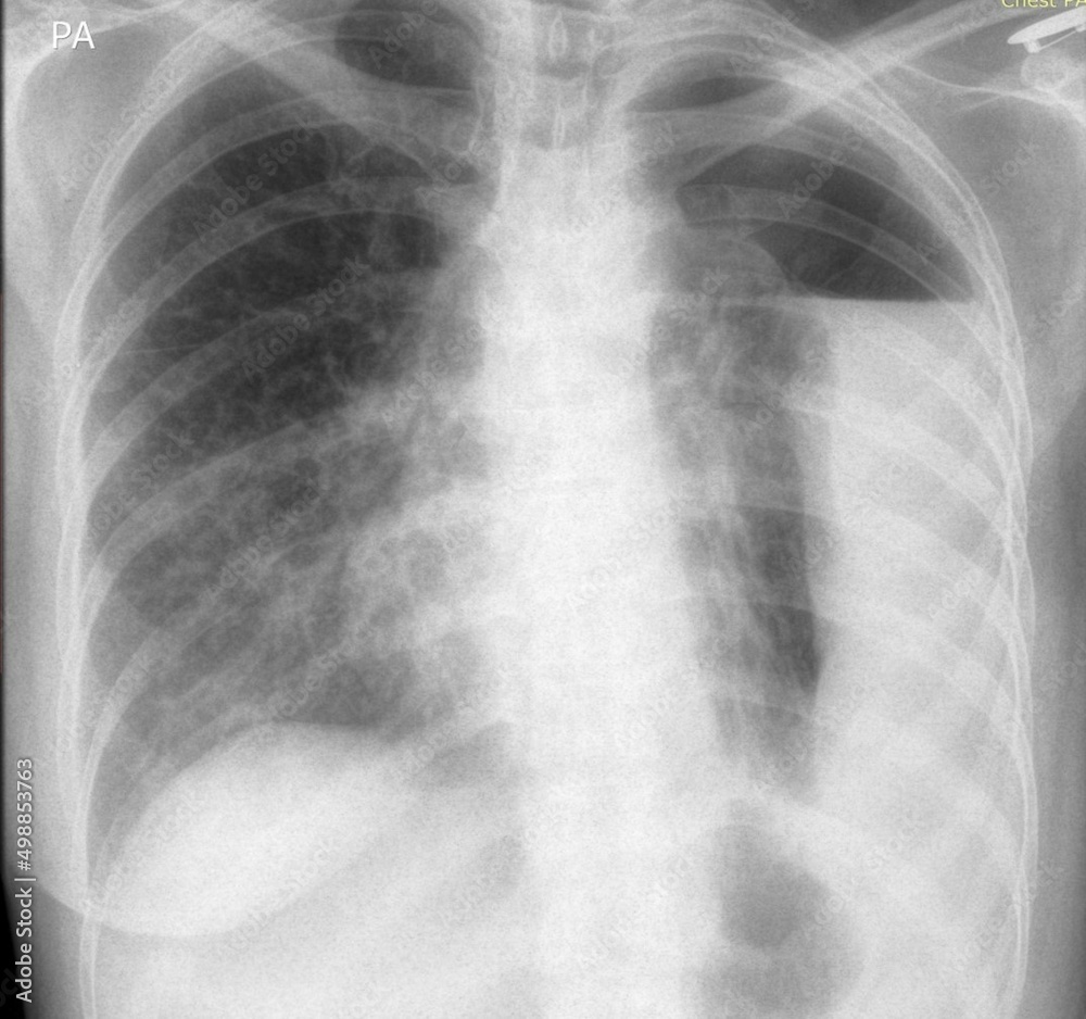 chest xray of hydropneumothorax
chest xray of hydropneumothorax