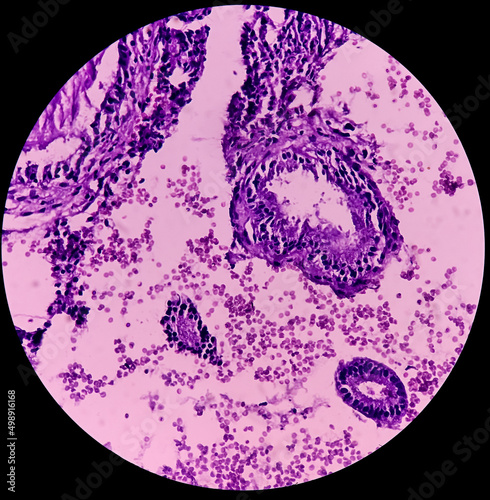 Endocervical tissue biopsy: Photomicrograph show part of ectocervix and few fragmented endocervical glands, Chronic endocervicitis. photo