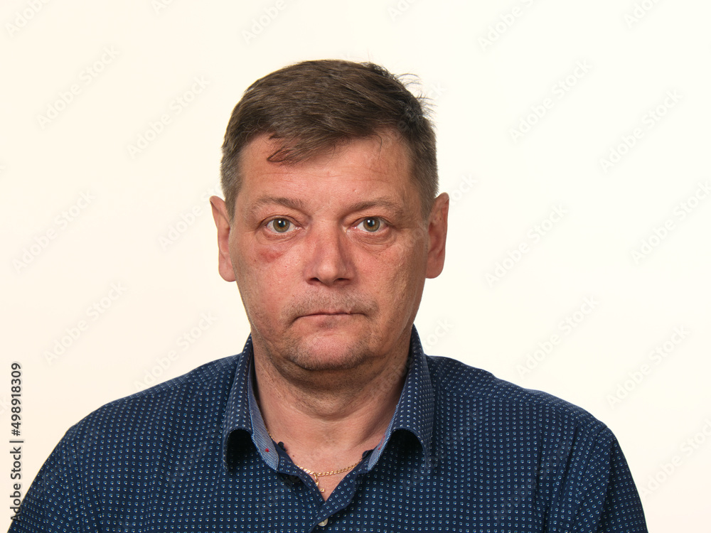 close-up portrait of a 50-year-old man with a swollen cheek and a black eye close-up portrait of a 50-year-old man with a swollen cheek and a black eye