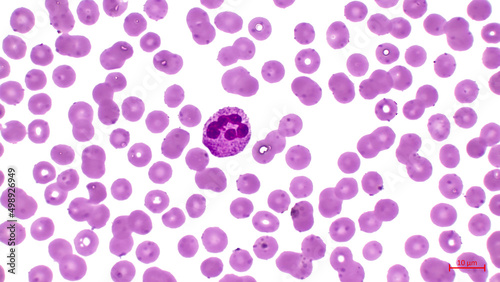 Light micrograph showing human blood cells. Erythrocytes are pink. They make up the majority of blood cells. Also in the center you can see a large cell with a nucleus (neutrophil). 
