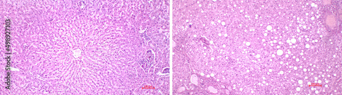 Light microscopy of the liver. Comparison of the structure (histology) of a healthy human liver (left) and the liver affected by Fatty disease (right). Hematoxylin and eosin stain. photo