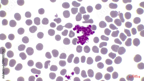 A smear of human blood is made in the laboratory. In the center Among erythrocytes there is a large number of violet thrombocytes (platelet). photo