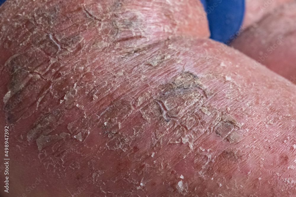 Fototapeta premium Closeup of cracked and dry skin disease. Medical healthcare concept. Cosmetology dermatology concept.