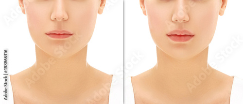 Beauty injections.Concept of rejuvenation.Lip augmentation