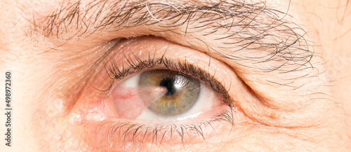 Close up of a eye of a senior man affected by pterygium photo
