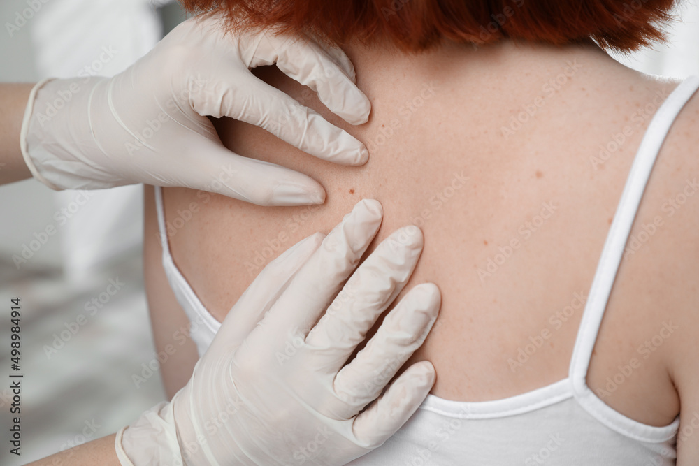 Dermatologist examining patient's birthmark in clinic, closeup view Dermatologist examining patient's birthmark in clinic, closeup view