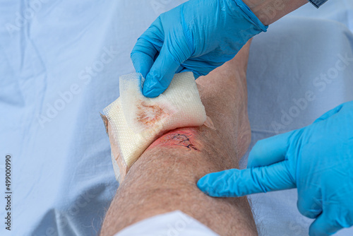 Nurse caring fresh blooded injury wound on the tibial bone of the leg. photo