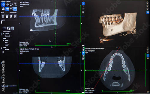 3D reconstruction from a CT image of a patient's jaw for personalized.