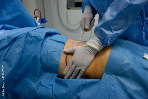 Photography Cosmetic surgery liposuction aspiration of fat by a pump.