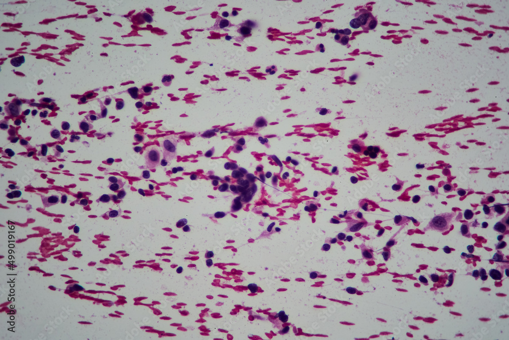 Microscopic image of ovarian tumor. Serous papillary cancer