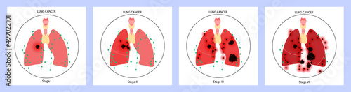 Lungs cancer disease