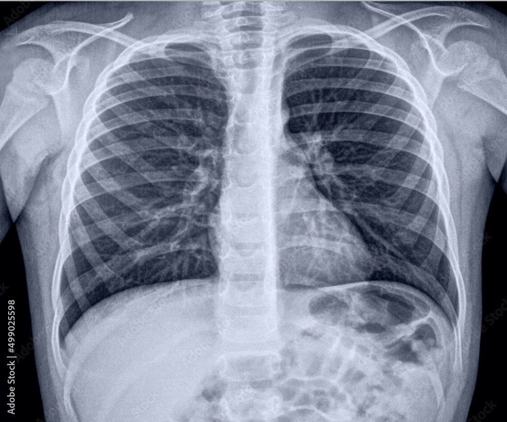 Photo Stock CHEST XRAY WITH COMPLICATED PNEUMONIA PLEURAL EFFUSION Adobe Stock